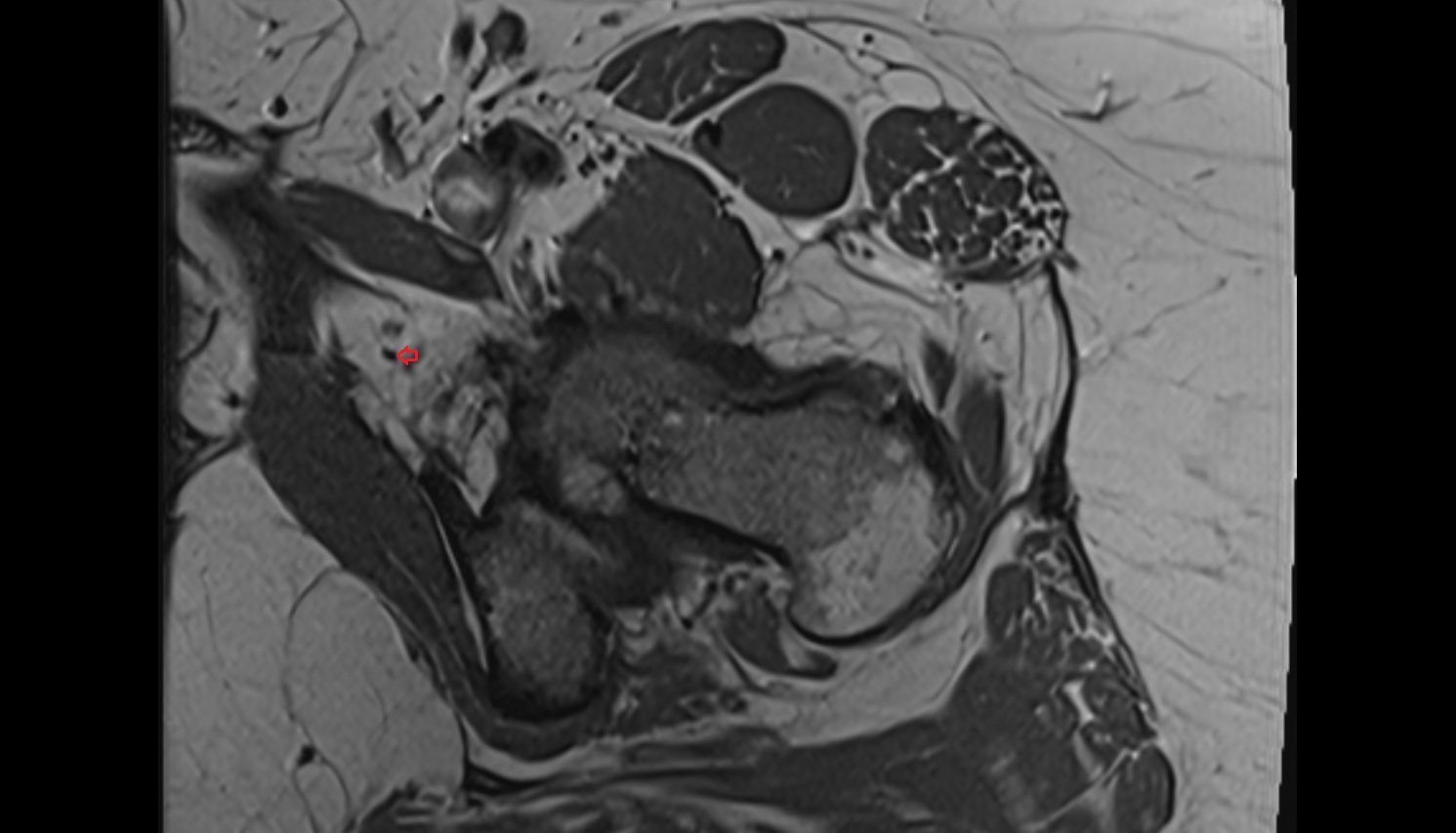 Posterior division of obturator nerve  MRI  axial  anatomy  image-img-00000-00000