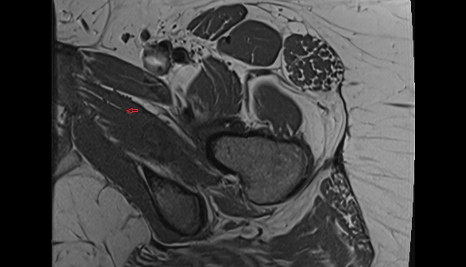 Posterior division of obturator nerve  MRI  axial  anatomy  image-img-00000-00000_00001