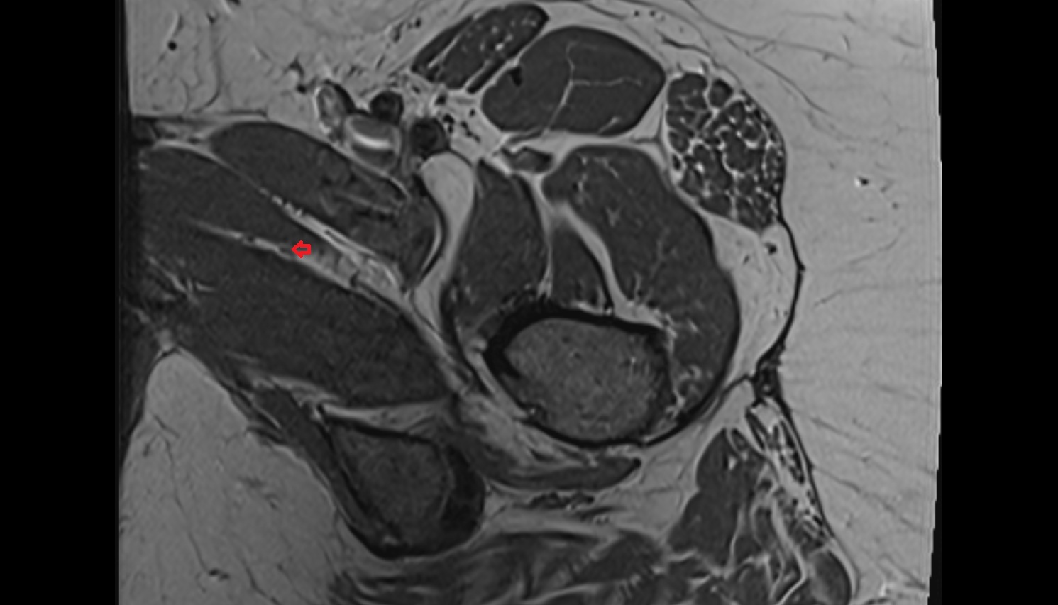 Posterior division of obturator nerve  MRI  axial  anatomy  image-img-00000-00000_00002