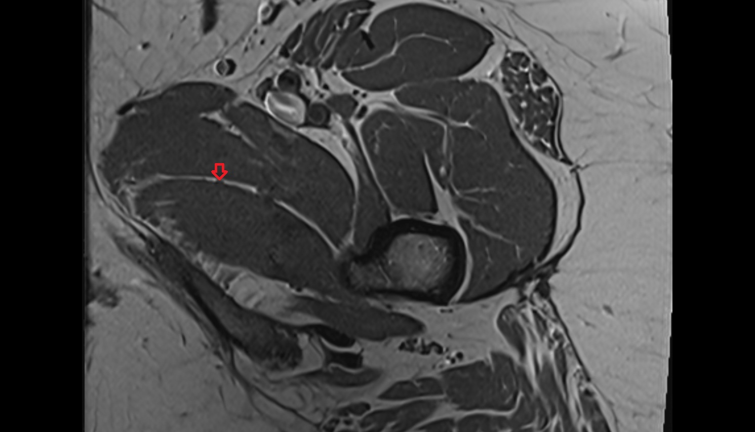 Posterior branch of obturator nerve