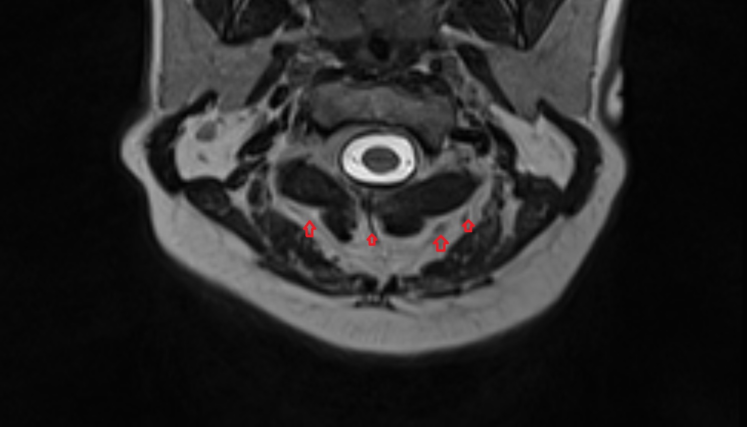 Posterior external vertebral venous plexus mri axial  image -img-00000-00000
