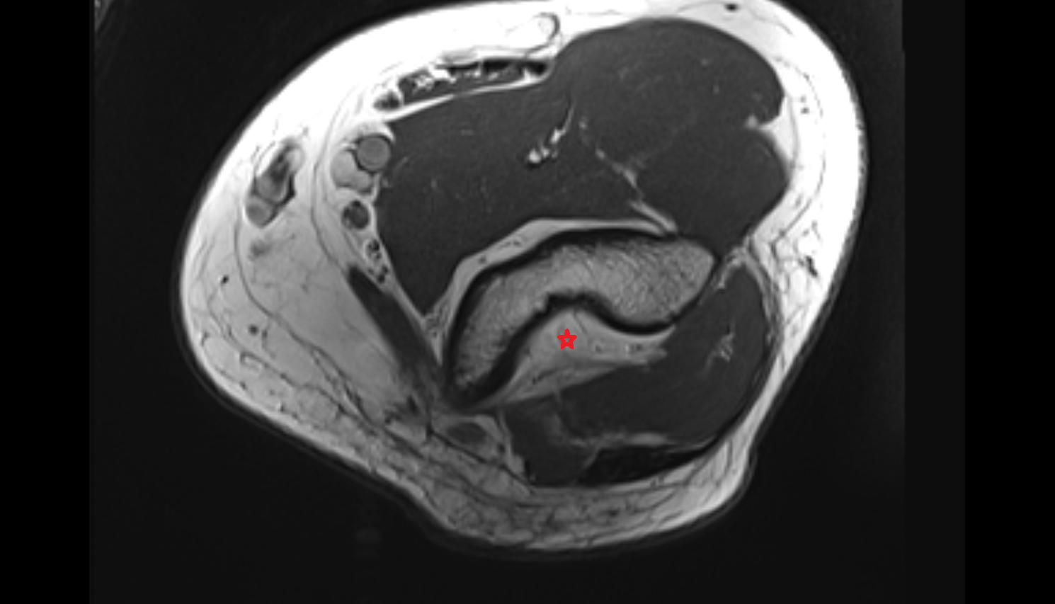 Posterior fat pad of elbow joint AXIAL cross sectional anatomy 3T MRI AI enhanced radiology image -img-00000-00000