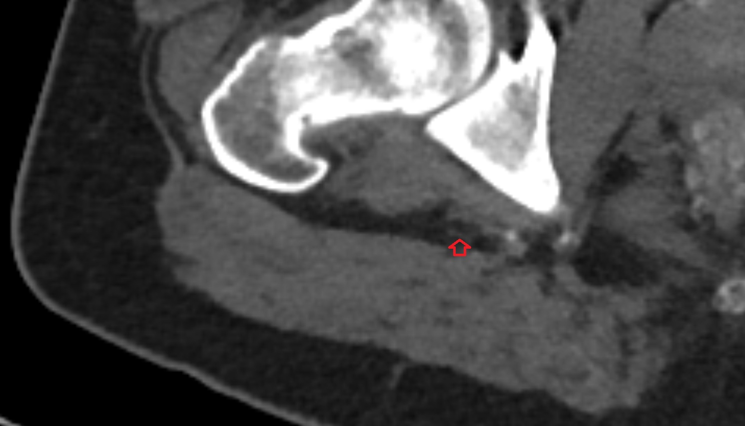 Posterior femoral cutaneous nerve   CT axial anatomy  image-img-00000-00000_00001