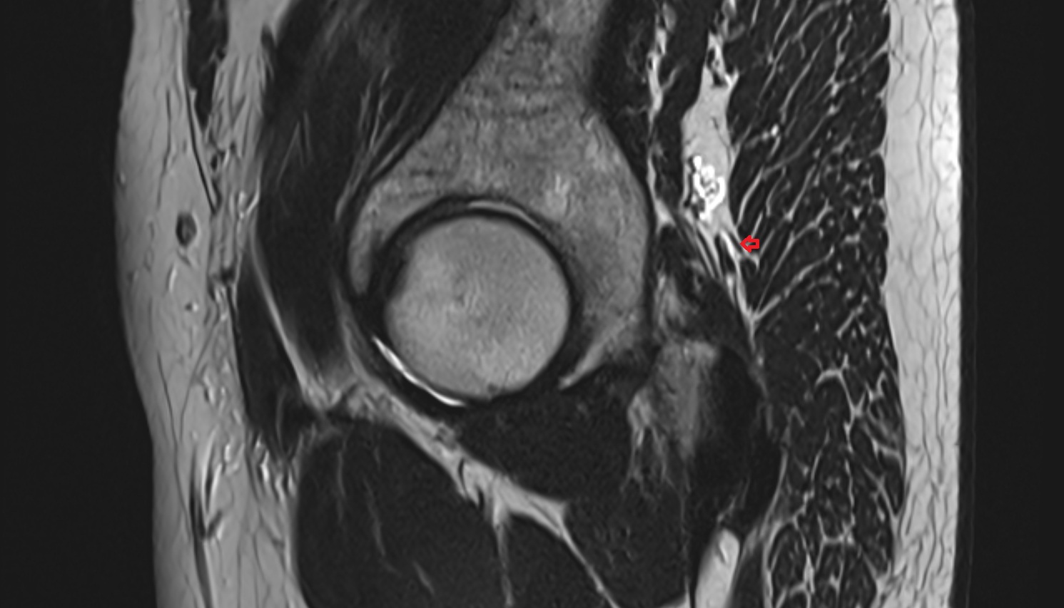 Posterior femoral cutaneous nerve   MRI  SAG anatomy  image-img-00000-00000