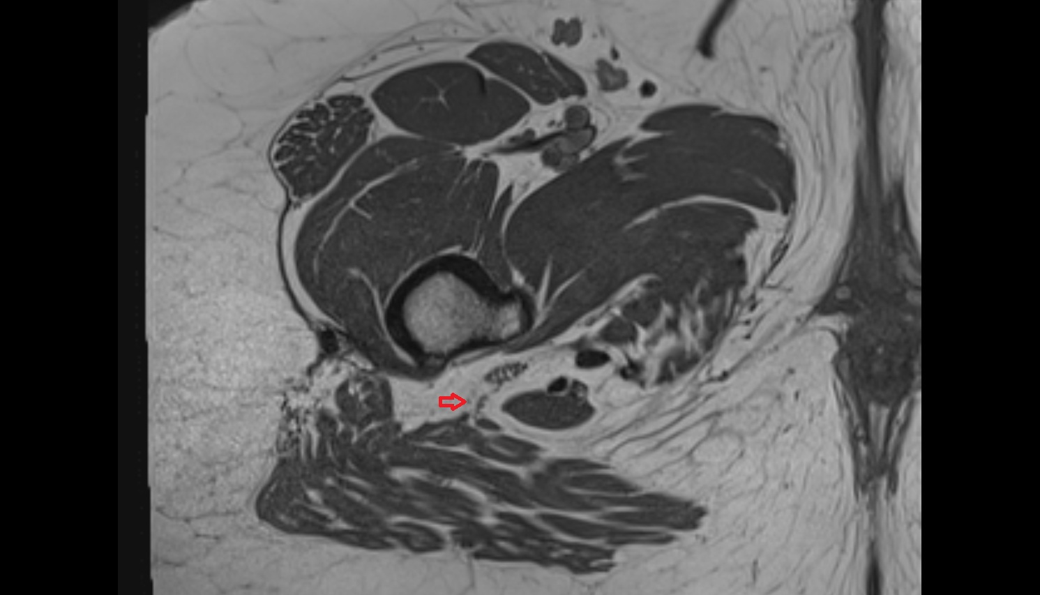 Posterior femoral cutaneous nerve   MRI  axial anatomy  image-img-00000-00000_00001