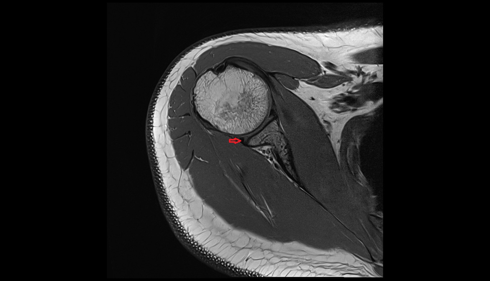 Posterior glenoid labrum