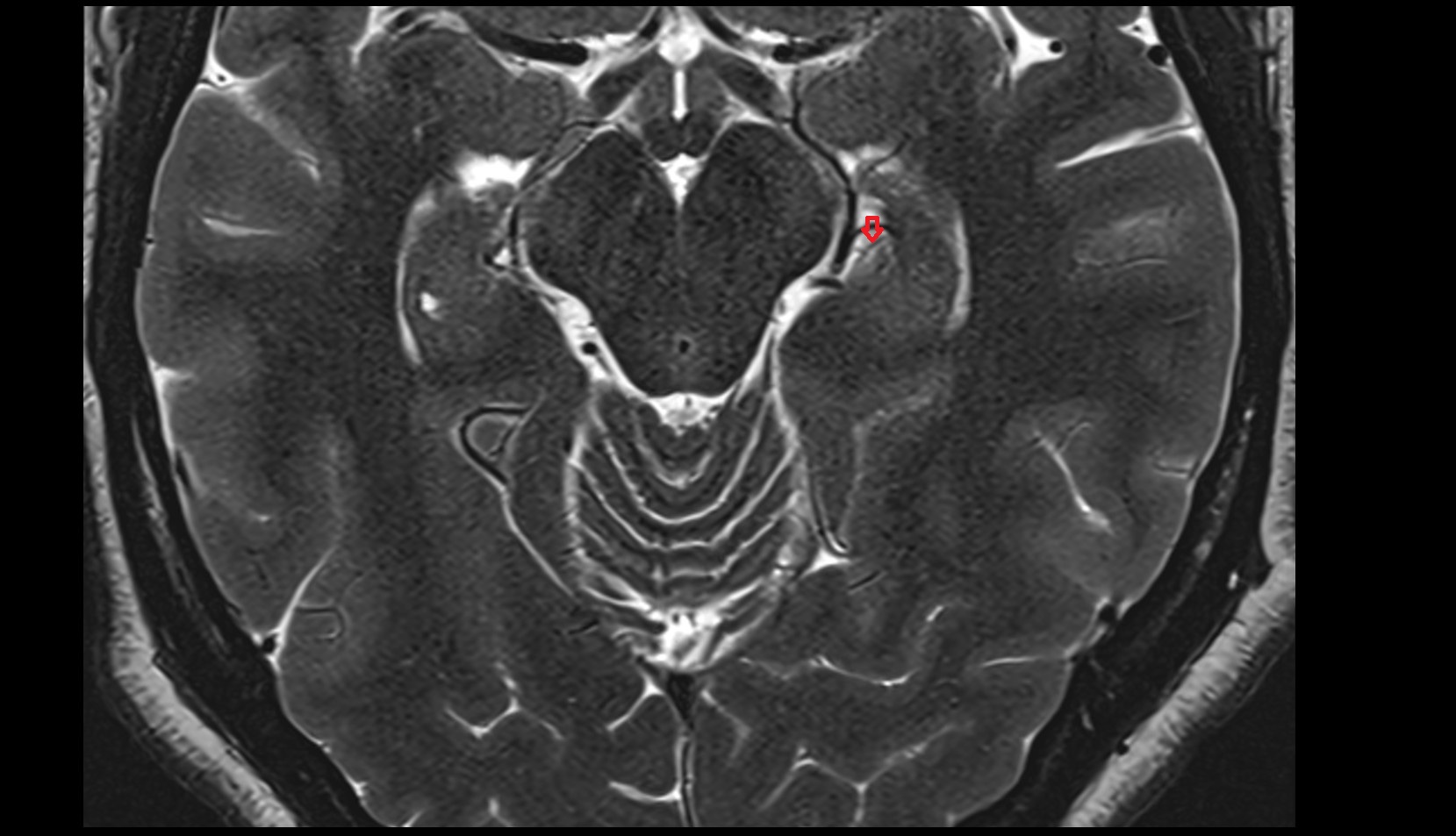 Posterior hippocampal artery