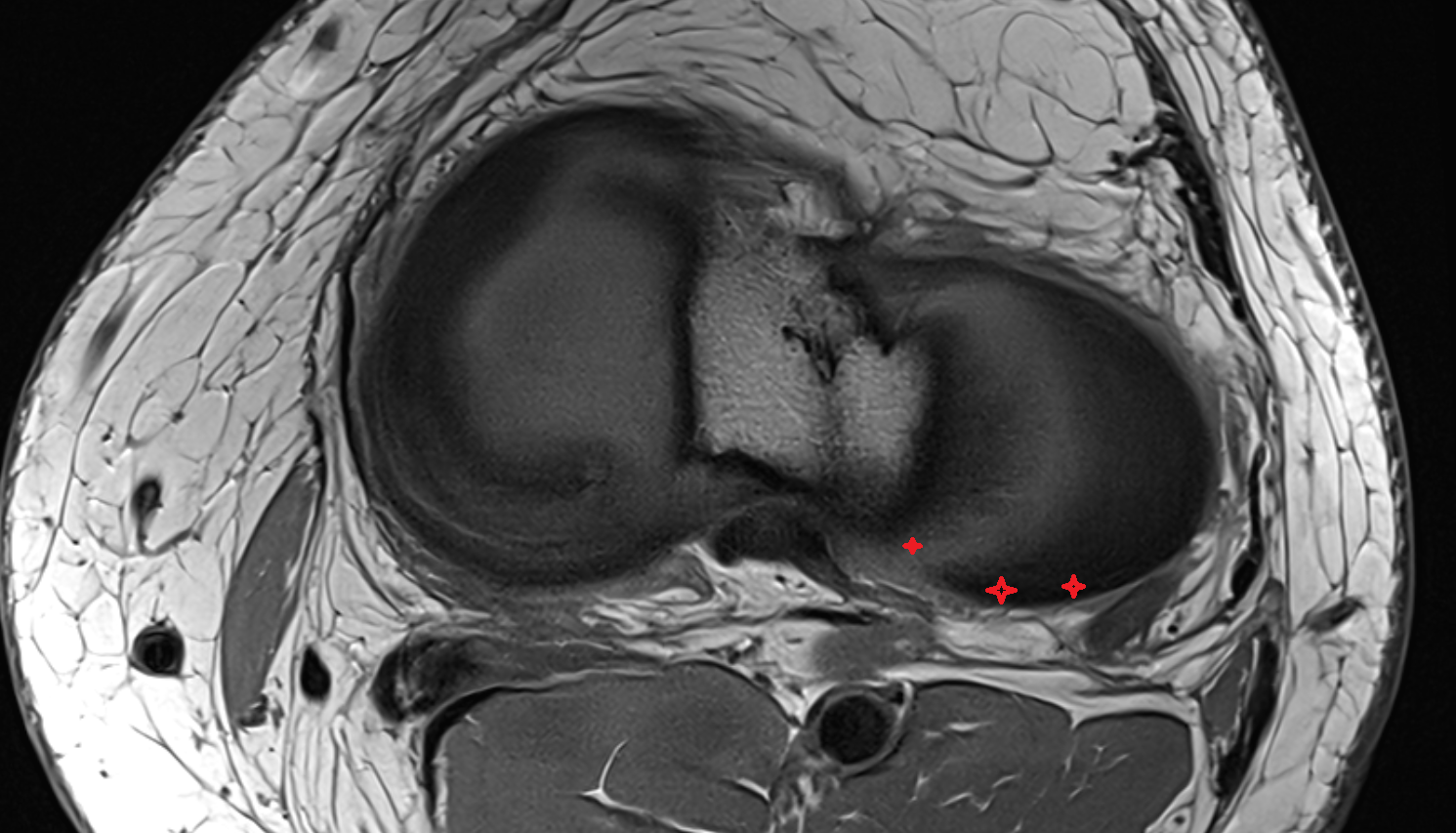 Posterior horn of lateral meniscus  axial  cross sectional anatomy 3T MRI AI enhanced  radiology  anatomy image-img-00000-00000