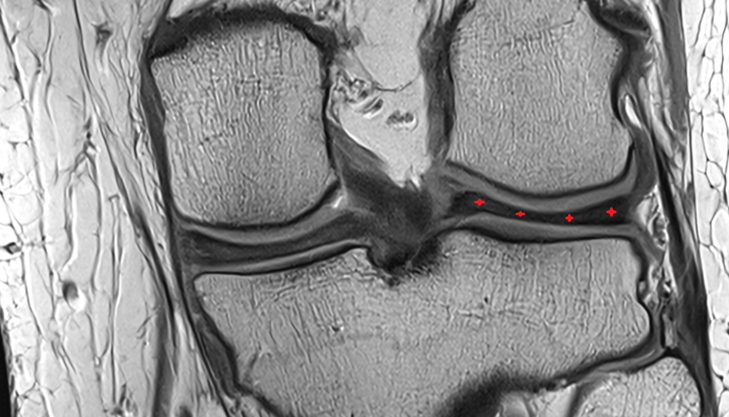 Posterior horn of lateral meniscus  coronal  cross sectional anatomy 3T MRI AI enhanced  radiology  anatomy image-img-00000-00000