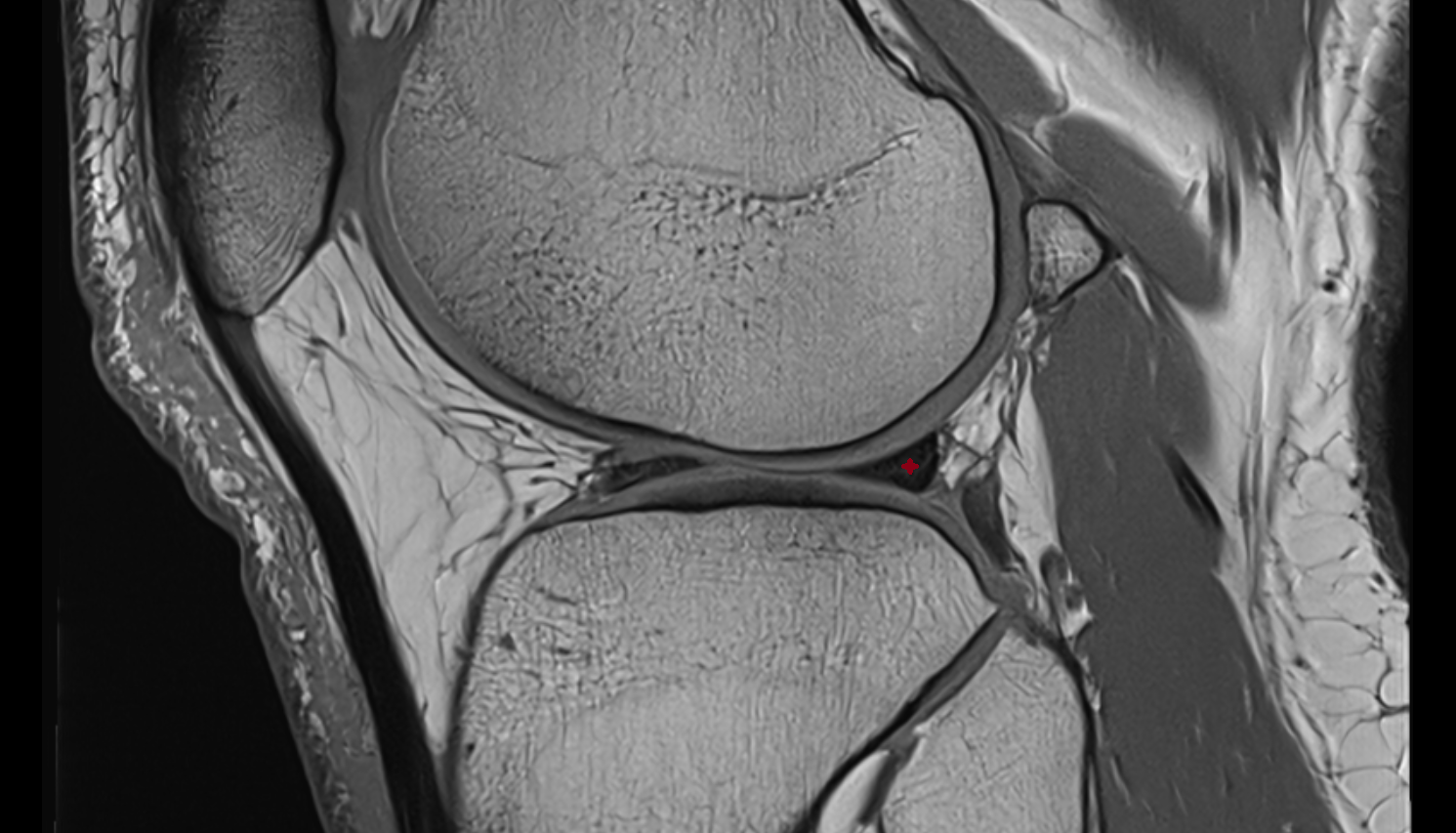 Posterior horn of lateral meniscus  sagittal  cross sectional anatomy 3T MRI AI enhanced  radiology  anatomy image-img-00000-00000