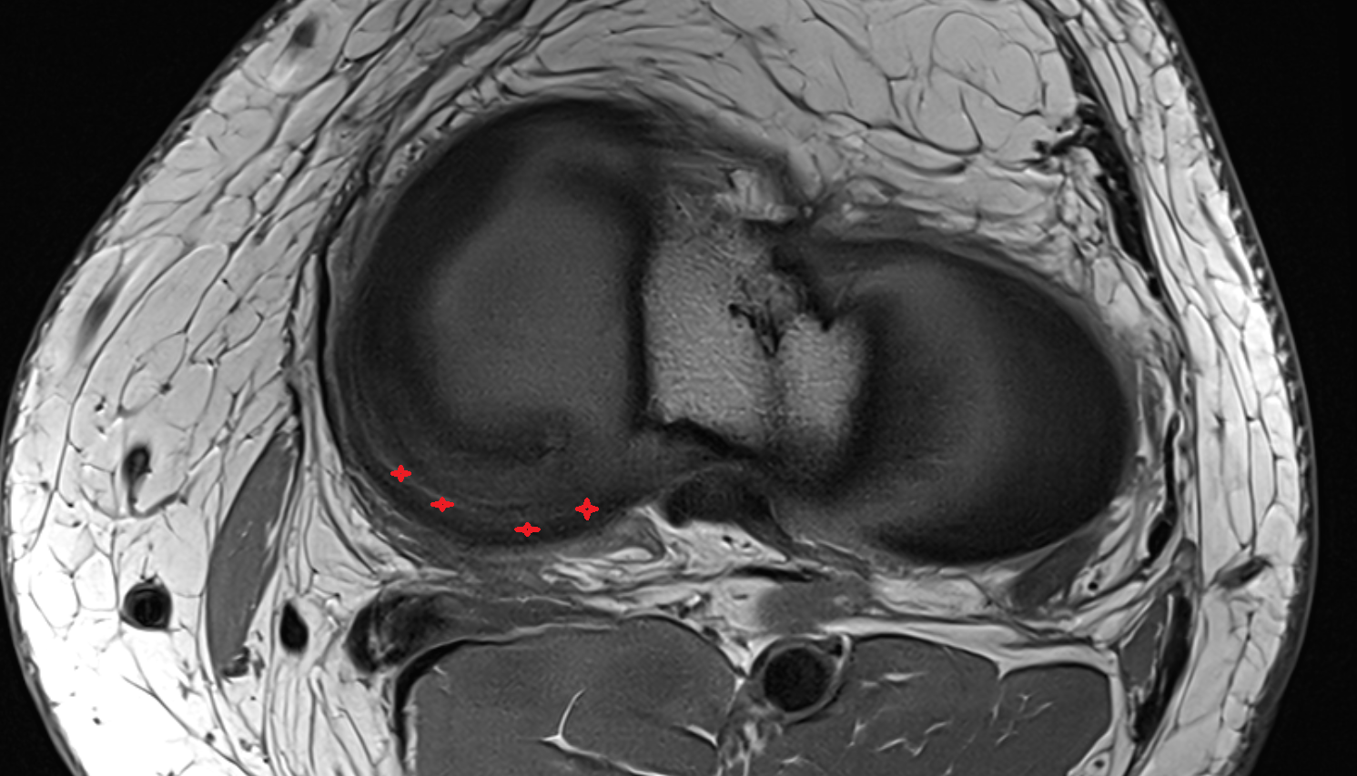 Posterior horn of medial meniscus  axial  cross sectional anatomy 3T MRI AI enhanced  radiology  anatomy image-img-00000-00000