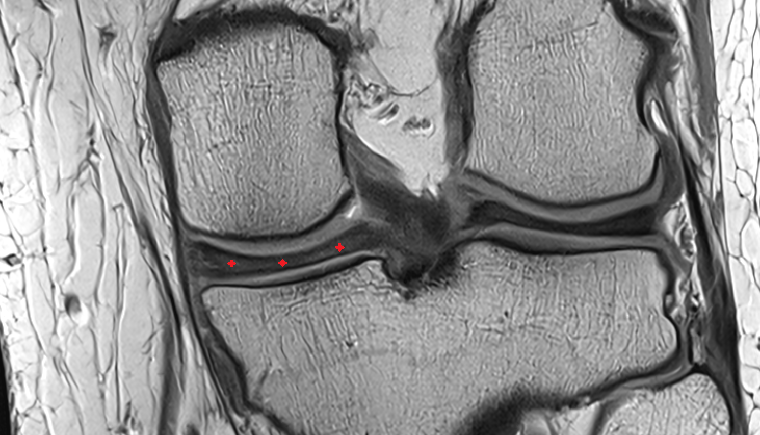 Posterior horn of medial meniscus coronal  cross sectional anatomy 3T MRI AI enhanced  radiology  anatomy image-img-00000-00000