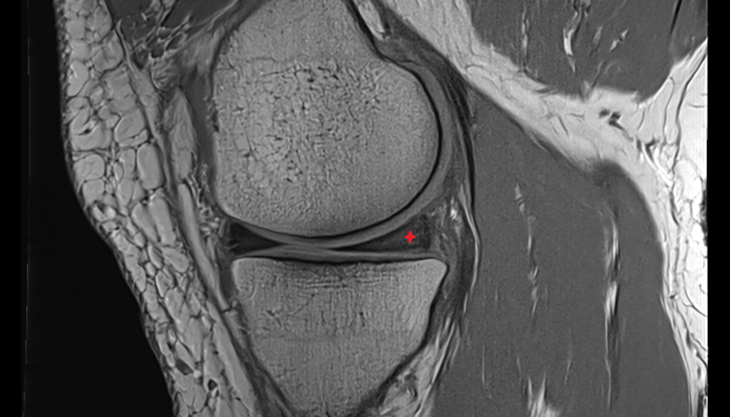 Posterior horn of medial meniscus  sagittal  cross sectional anatomy 3T MRI AI enhanced  radiology  anatomy image-img-00000-00000