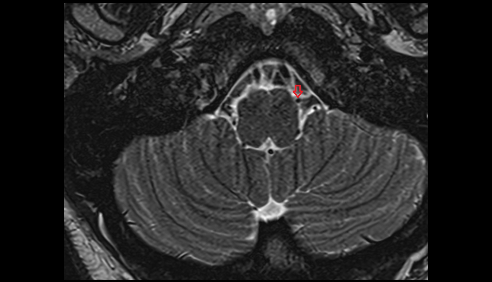 Posterior inferior cerebellar artery