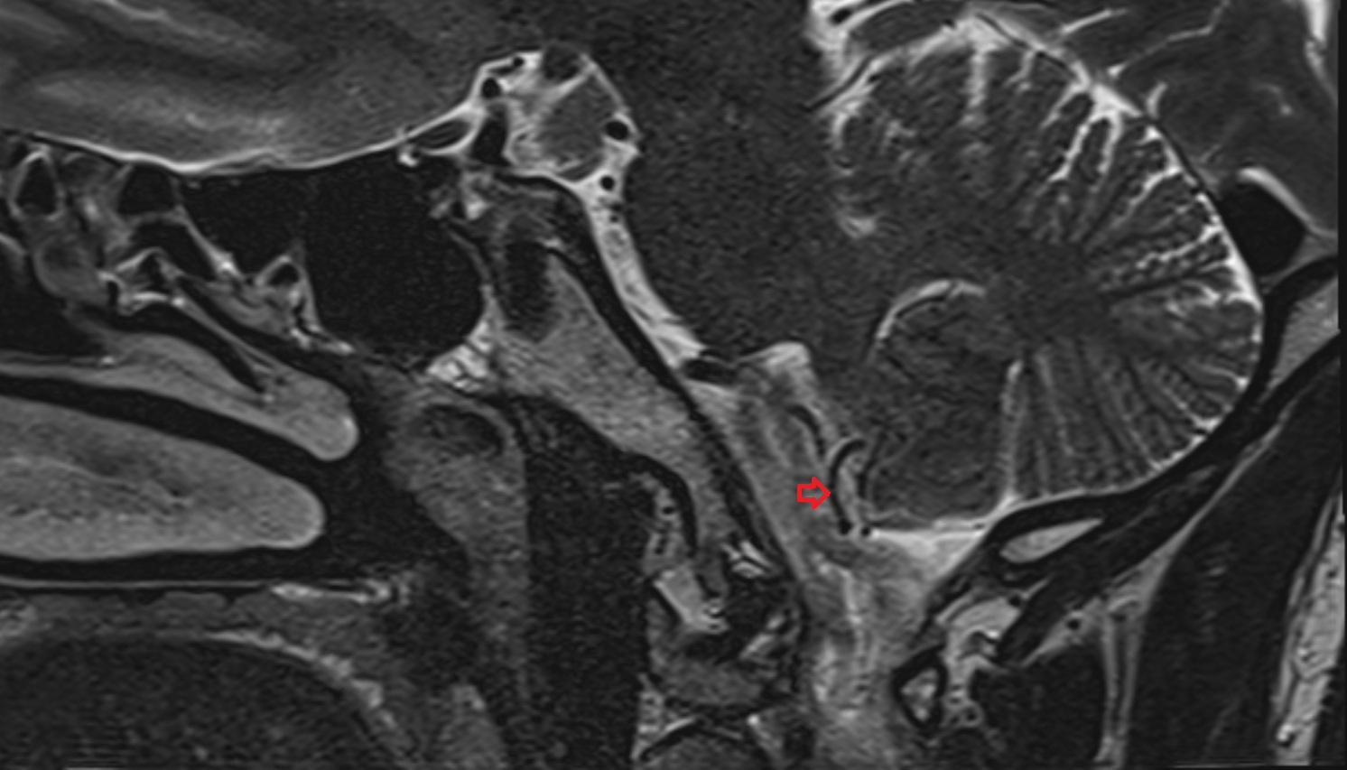 Posterior inferior cerebellar artery mri sag  image -img-00000-00000