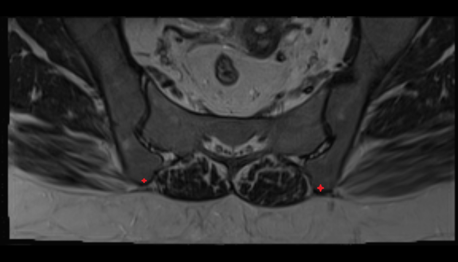 Posterior inferior iliac spine  MRI axial anatomy  image -img-00000-00000