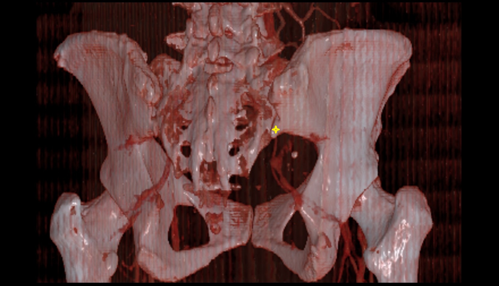 Posterior inferior iliac spine ct 3d image