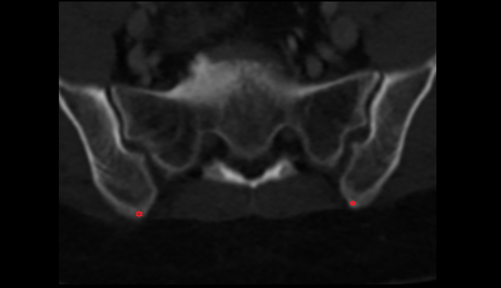 Posterior inferior iliac spine ct axial image