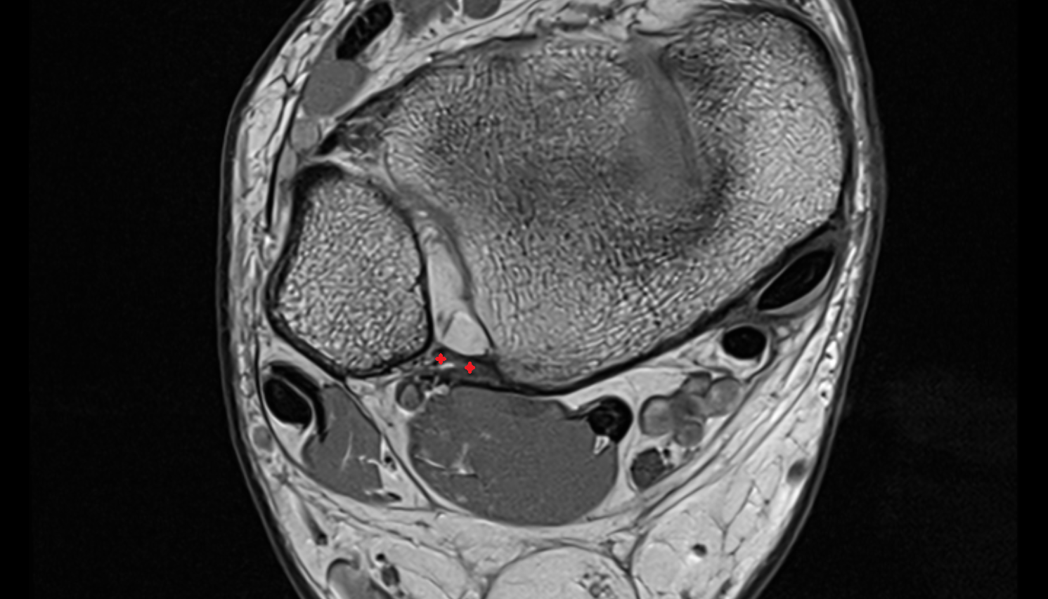 Posterior inferior tibiofibular ligament  Axial cross sectional anatomy 3T MRI AI enhanced radiology image-img-00000-00000