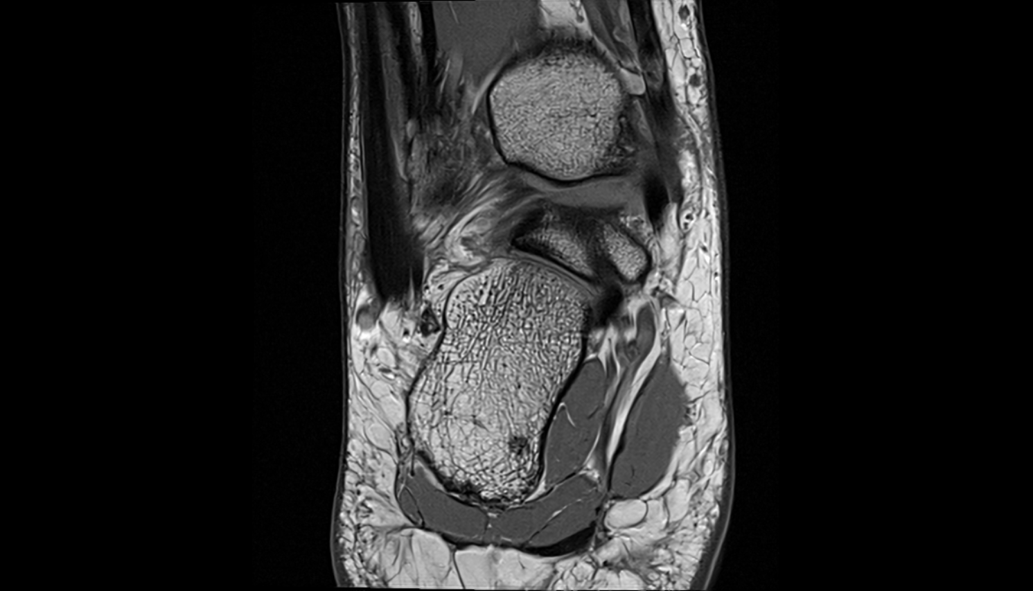 Posterior inferior tibiofibular ligament  coronal cross sectional anatomy 3T MRI AI enhanced radiology image-img-00000-00000_00001