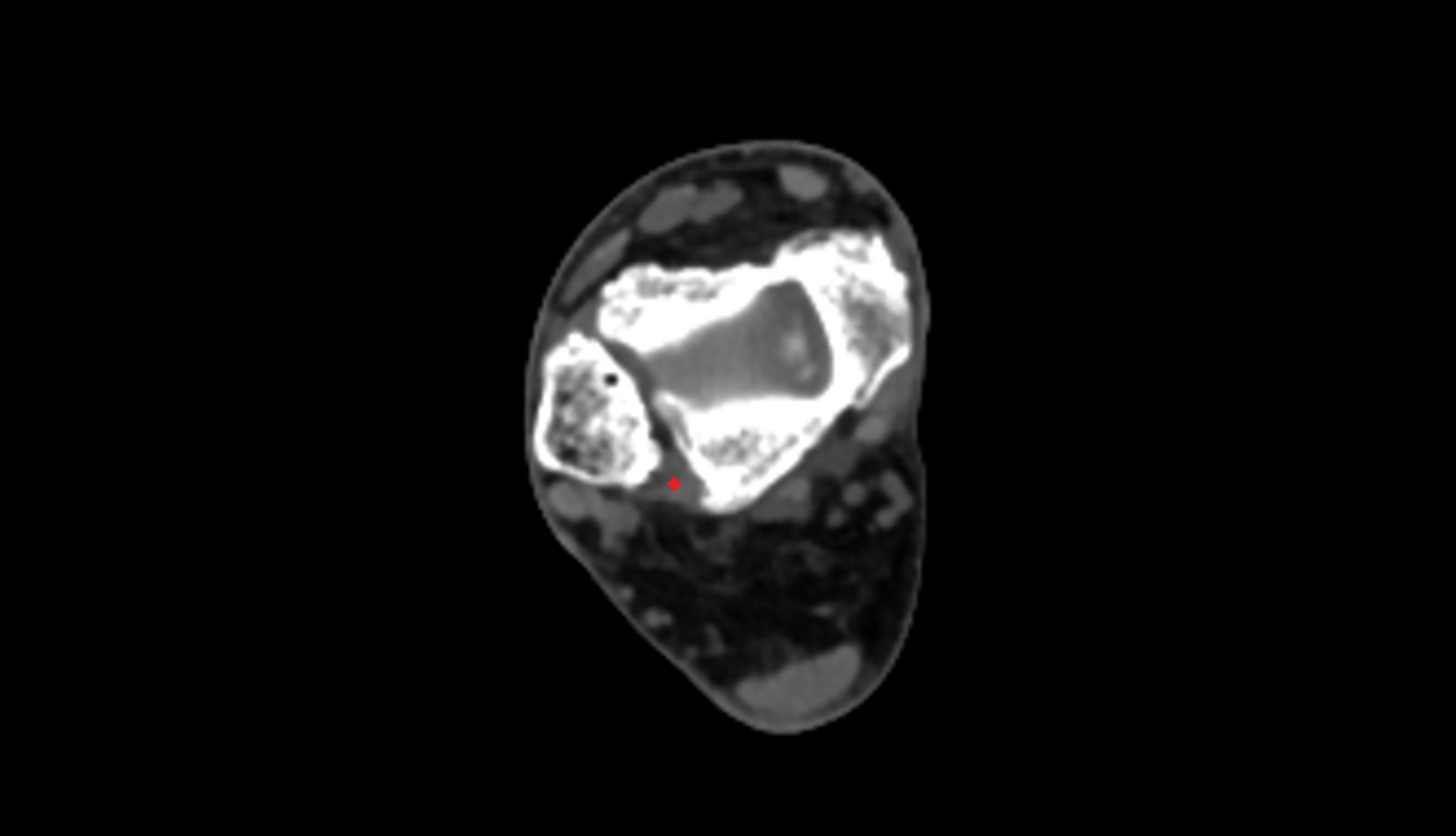 Posterior inferior tibiofibular ligament ct image