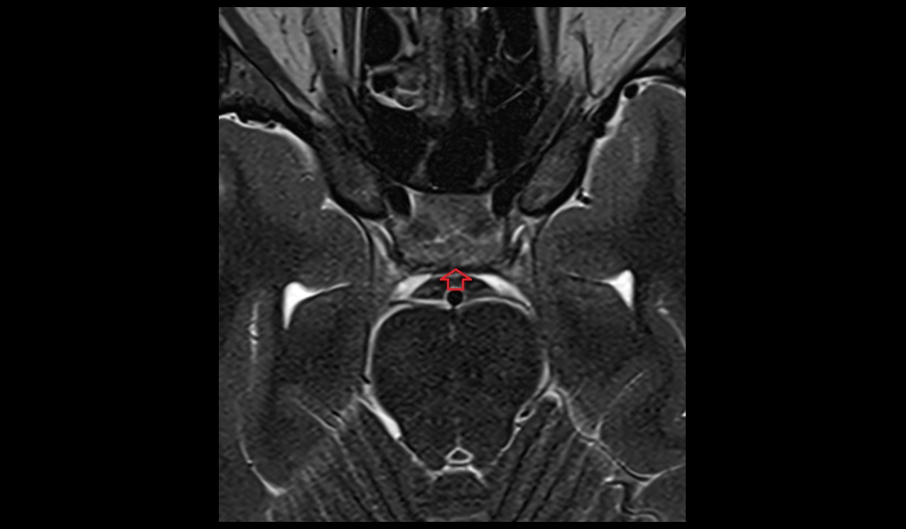 Posterior intercavernous sinus mri axial image