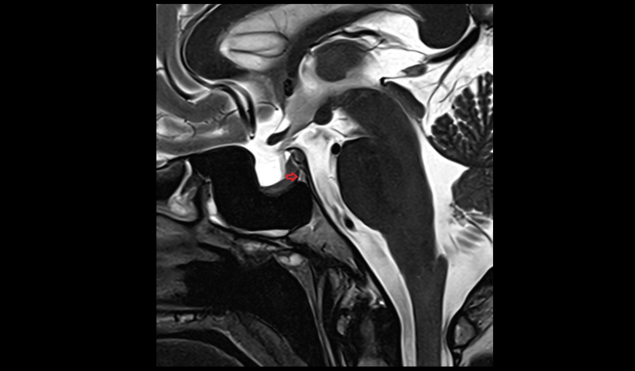 Posterior intercavernous sinus mri sagittal image