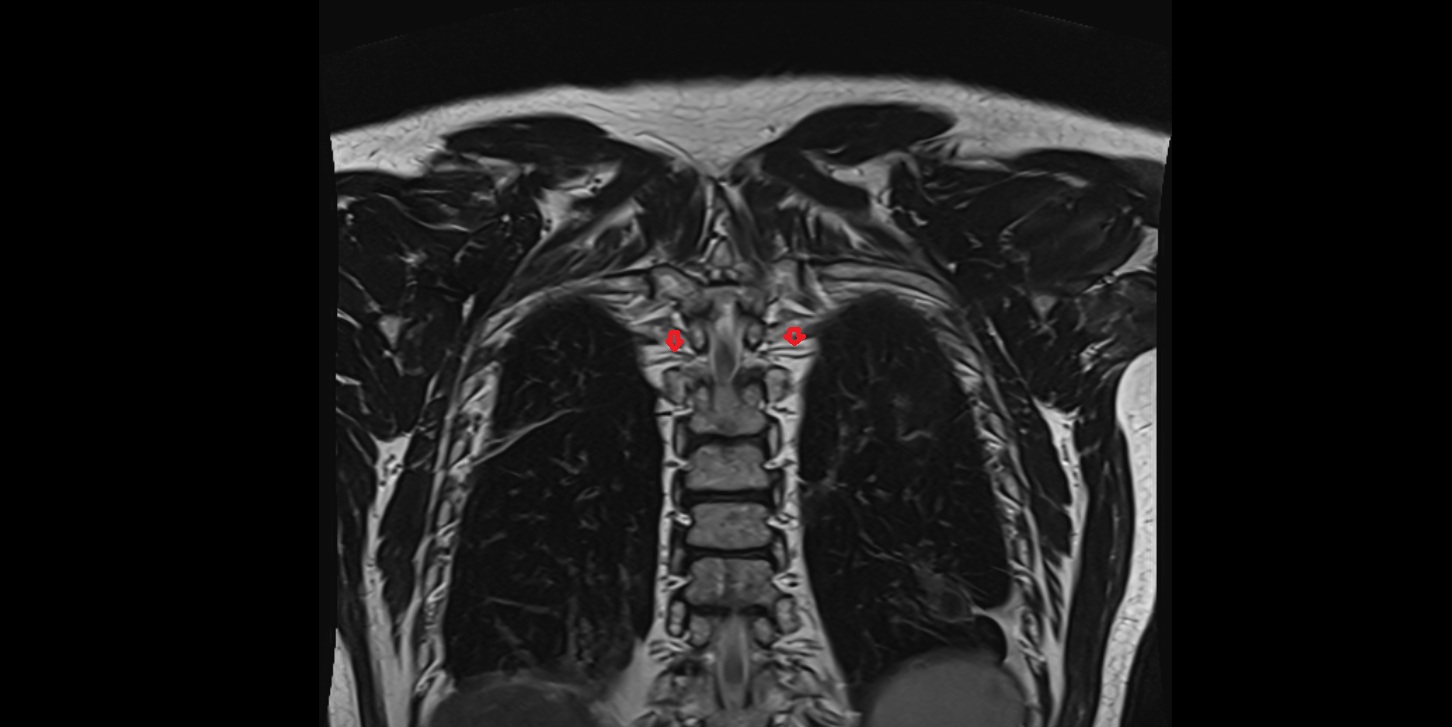 Posterior intercostal arteries MRI CORONAL  image -img-00000-00000