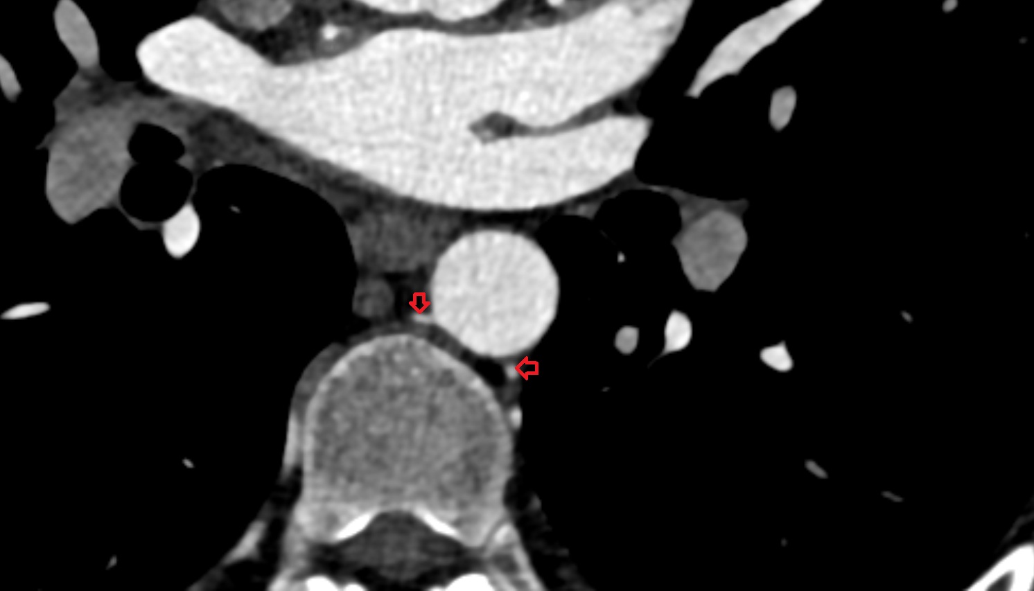 Posterior intercostal arteries  anatomy CT axial  image -img-00000-00000