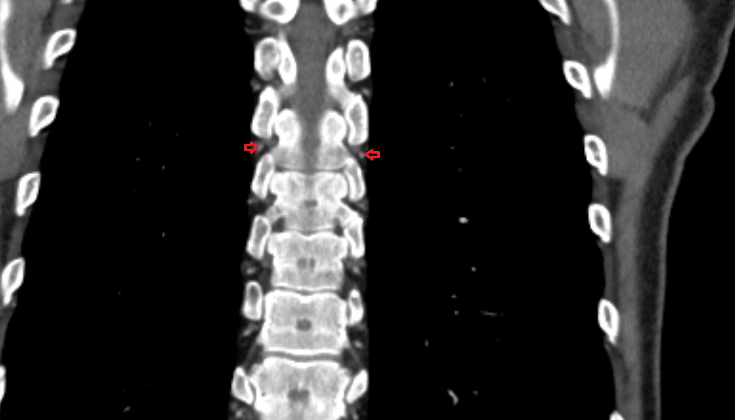 Posterior intercostal arteries ct CORONAL  image -img-00000-00000