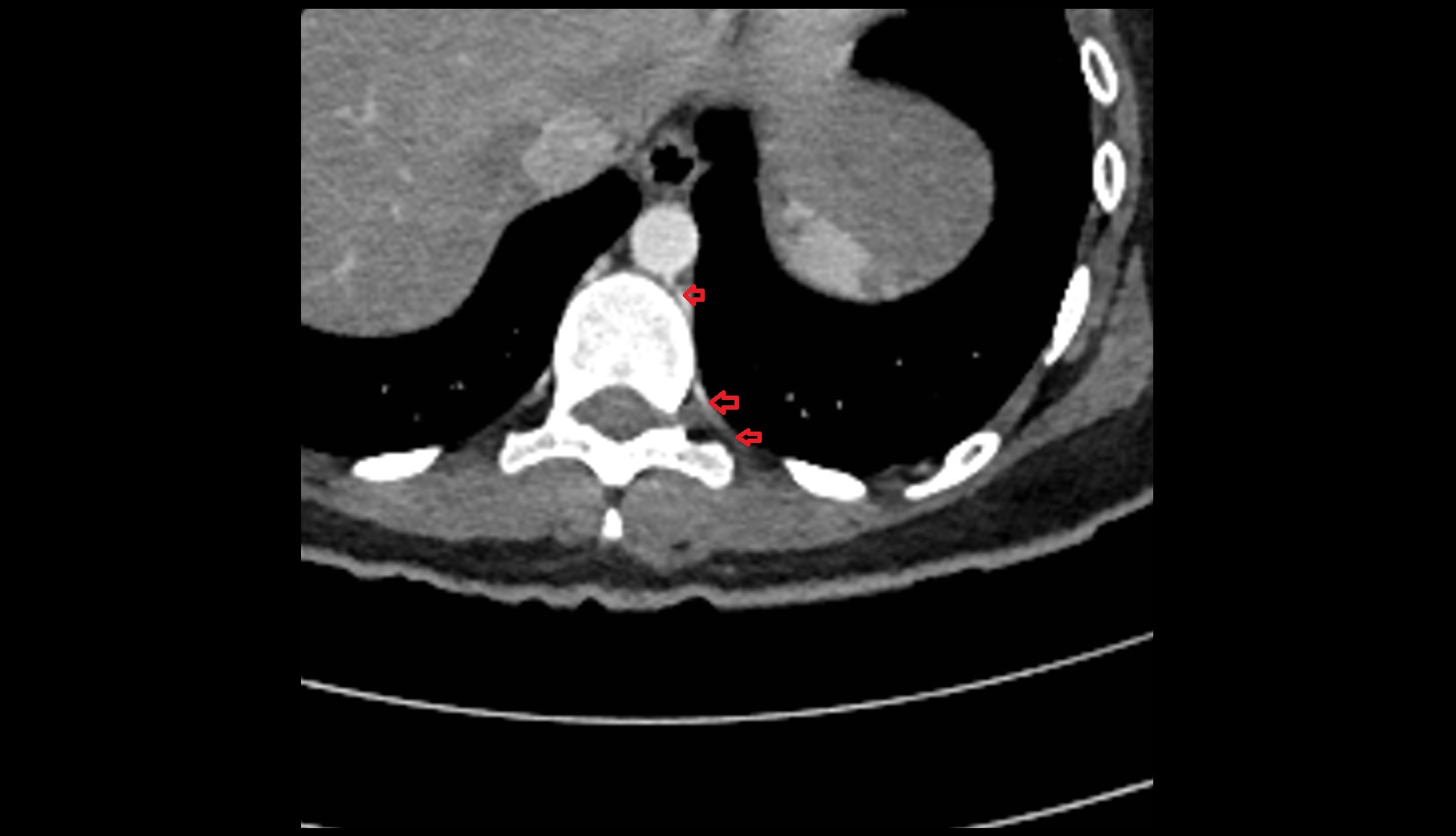Posterior intercostal artery