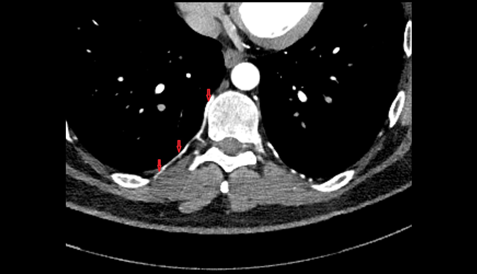Posterior intercostal artery.jpg1