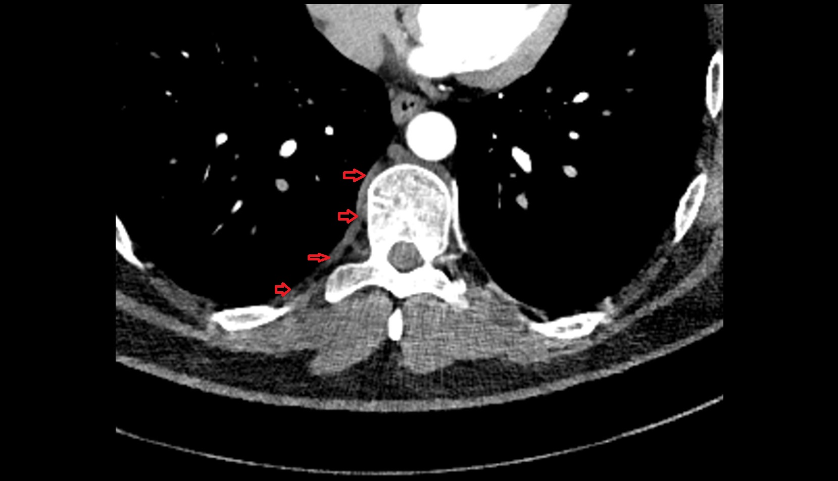 Posterior intercostal veins CT axial