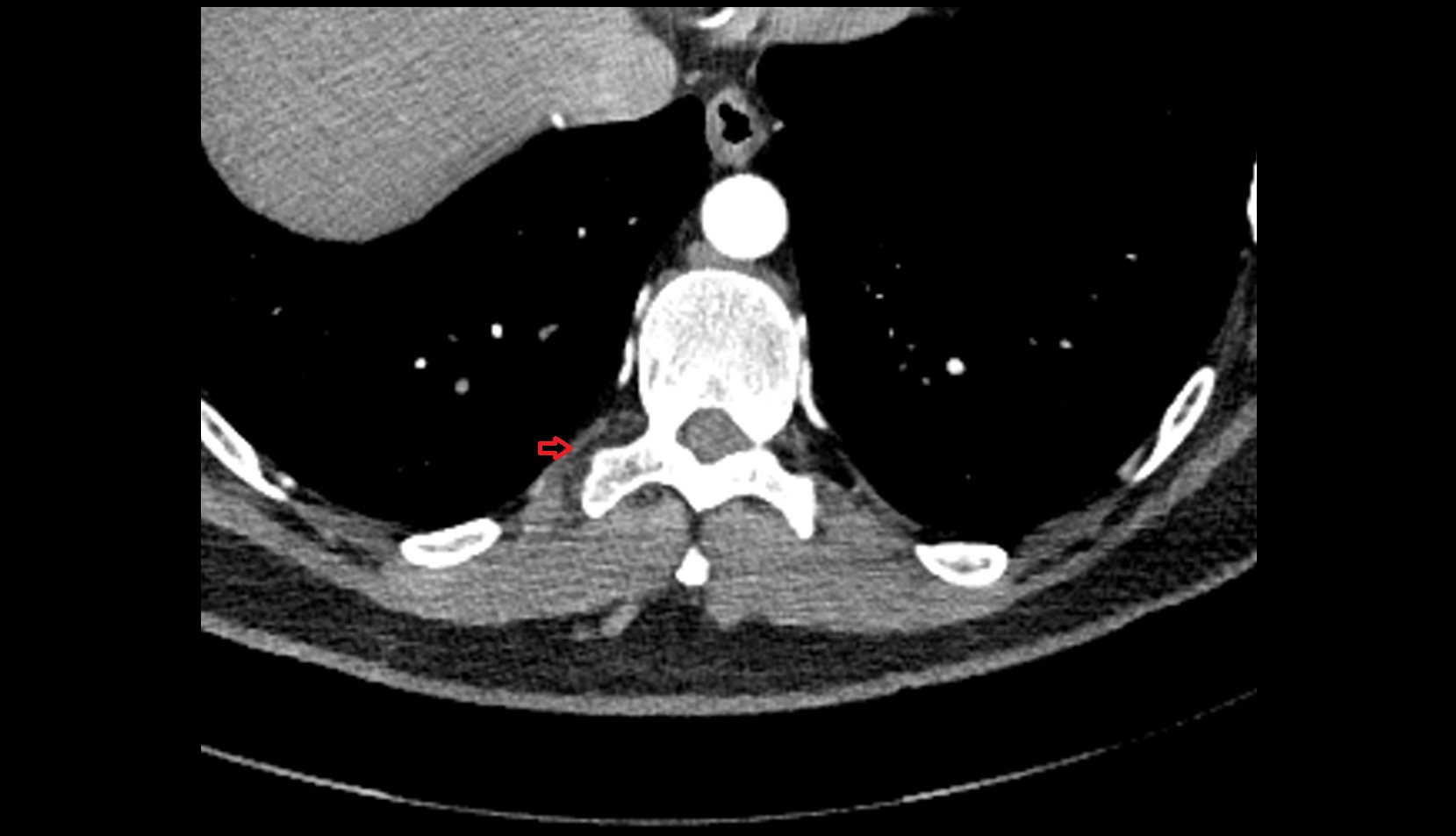 Posterior intercostal veins CT axial 1