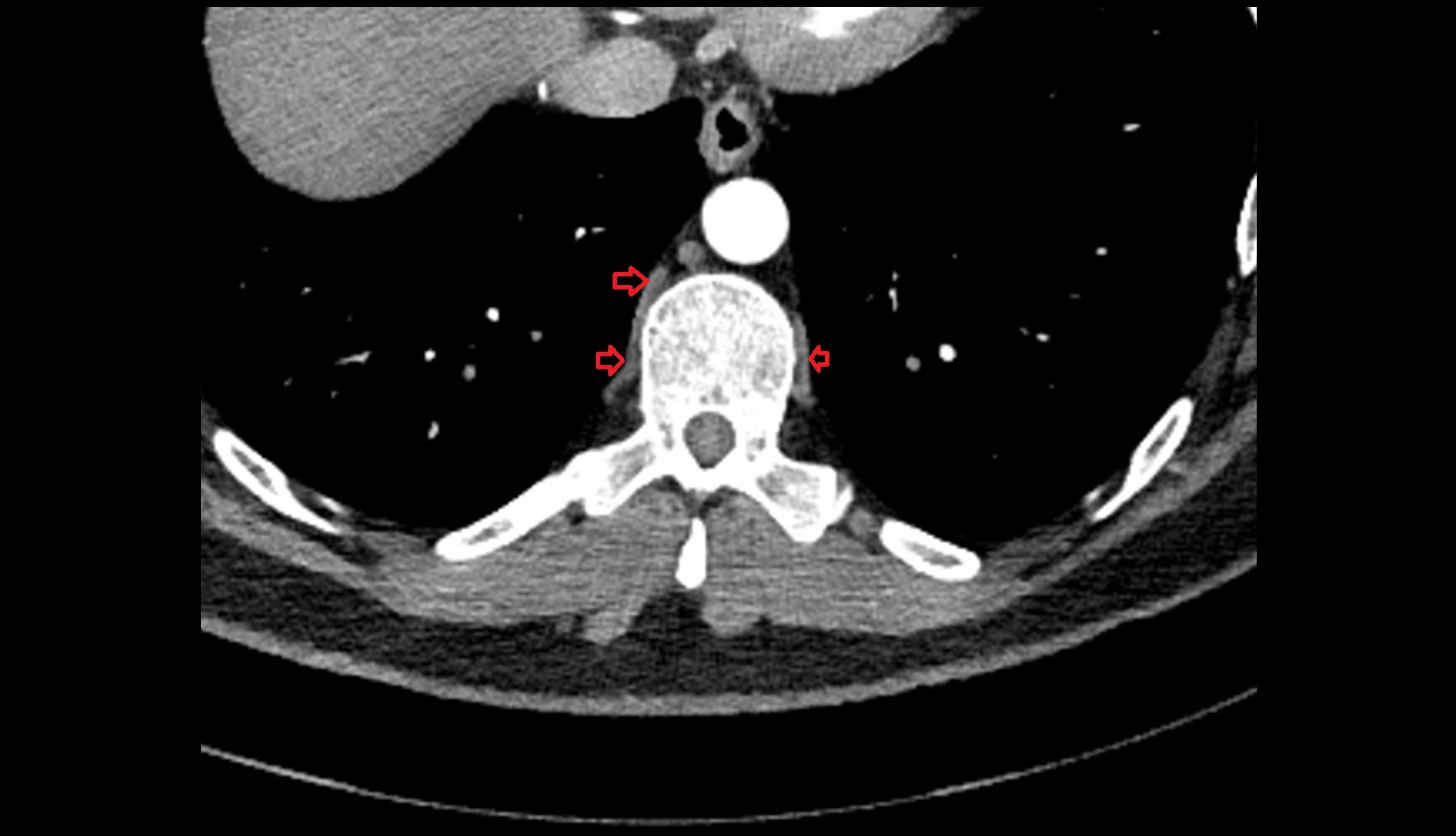 Posterior intercostal veins CT axial  2