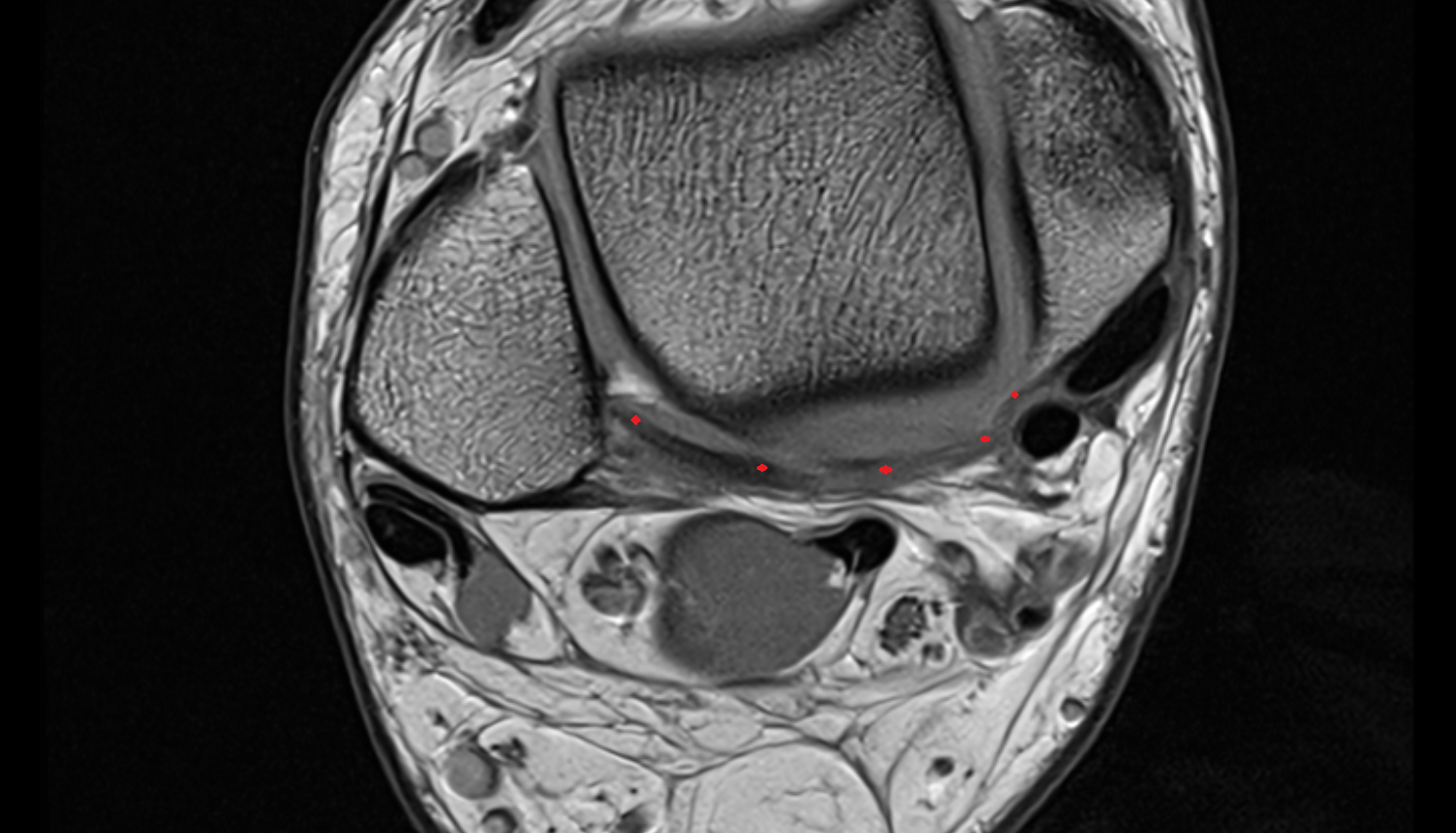 Posterior intermalleolar ligament  axial cross sectional anatomy 3T MRI AI enhanced radiology image-img-00000-00000