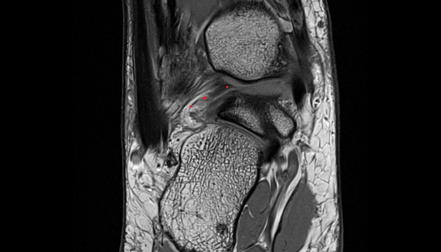Posterior intermalleolar ligament  coronal cross sectional anatomy 3T MRI AI enhanced radiology image-img-00000-00000