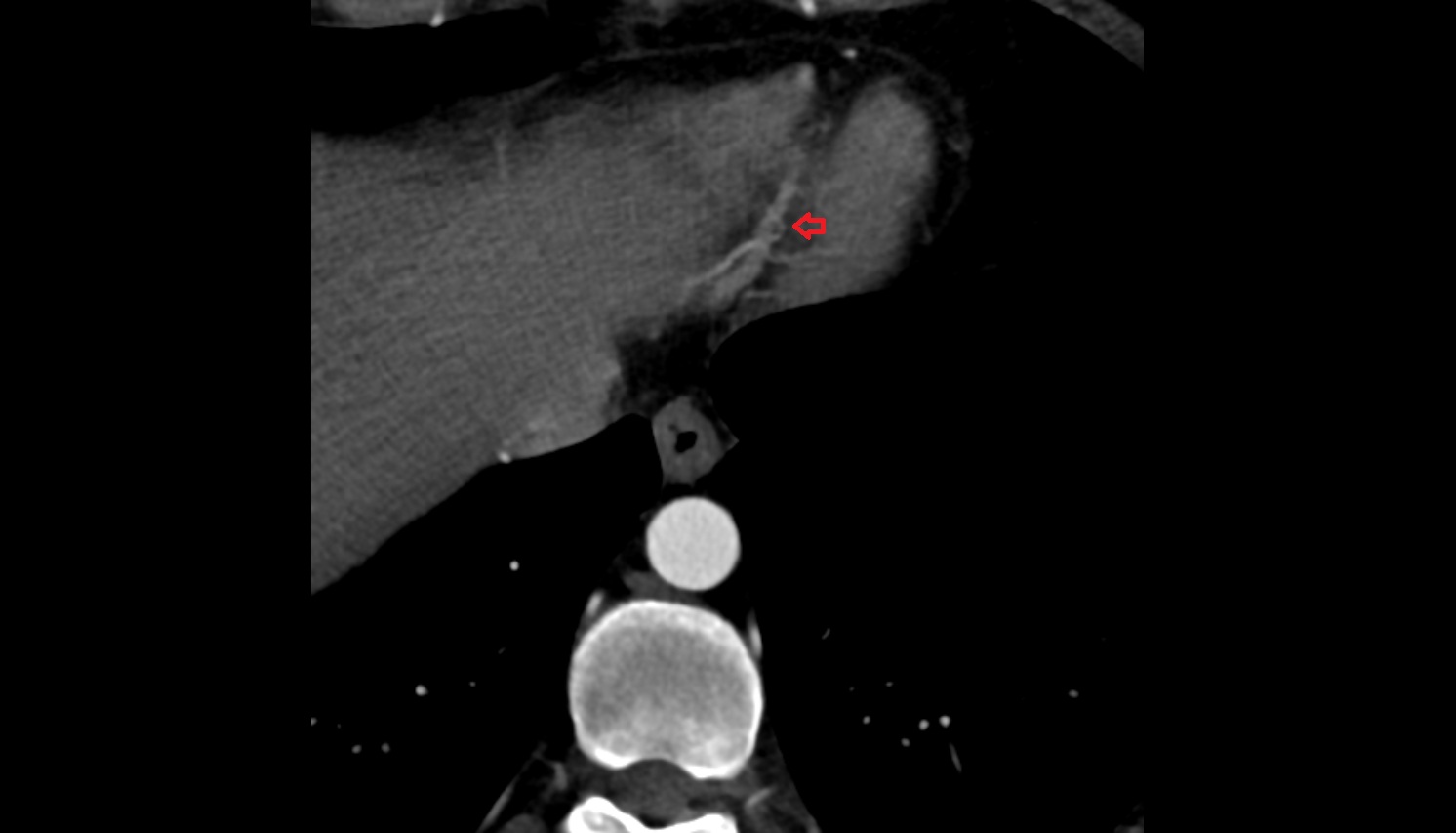 Posterior interventricular sulcus anatomy CT axial image -img-00000-00000_00001