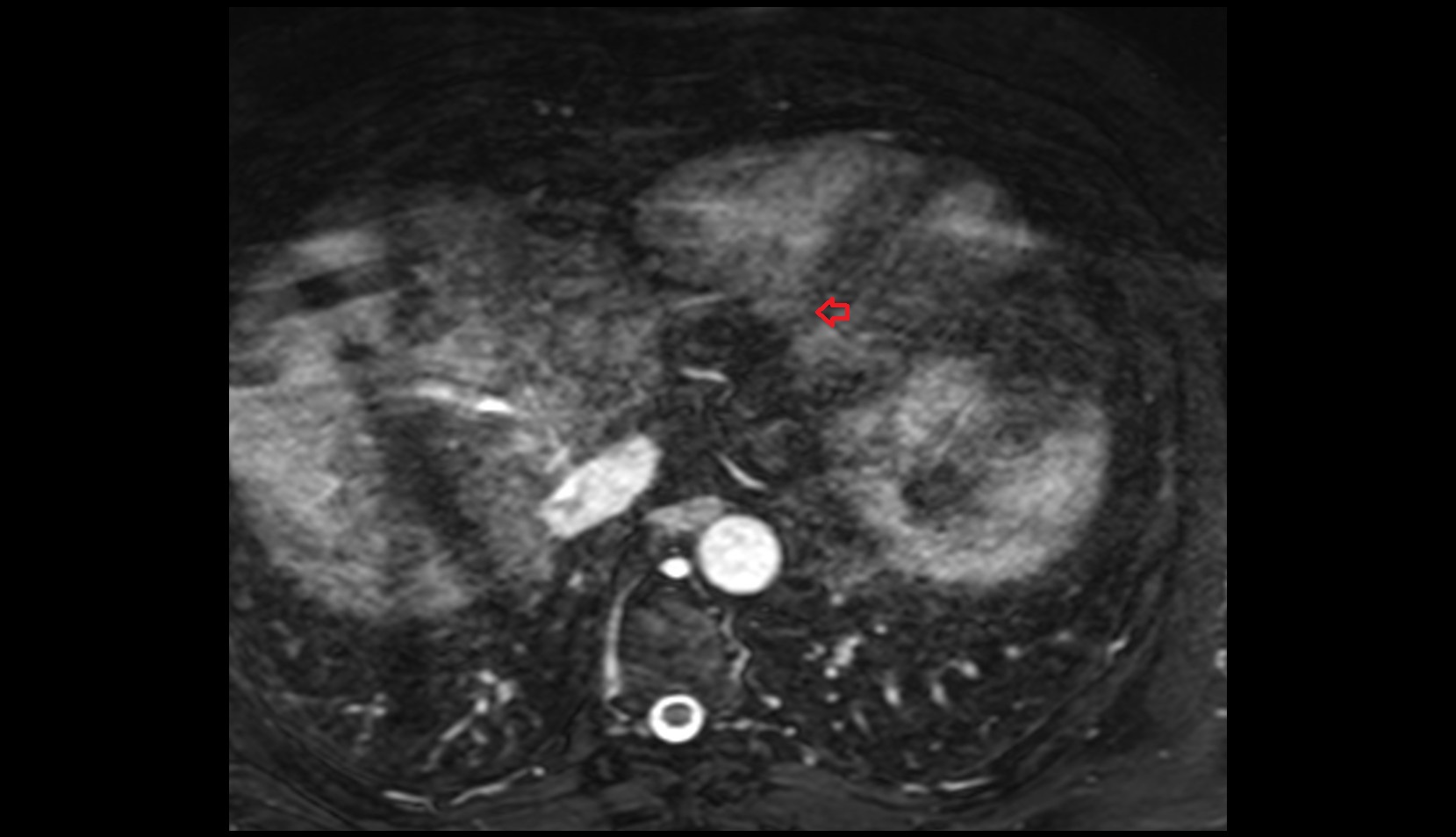 Posterior interventricular sulcus mri image