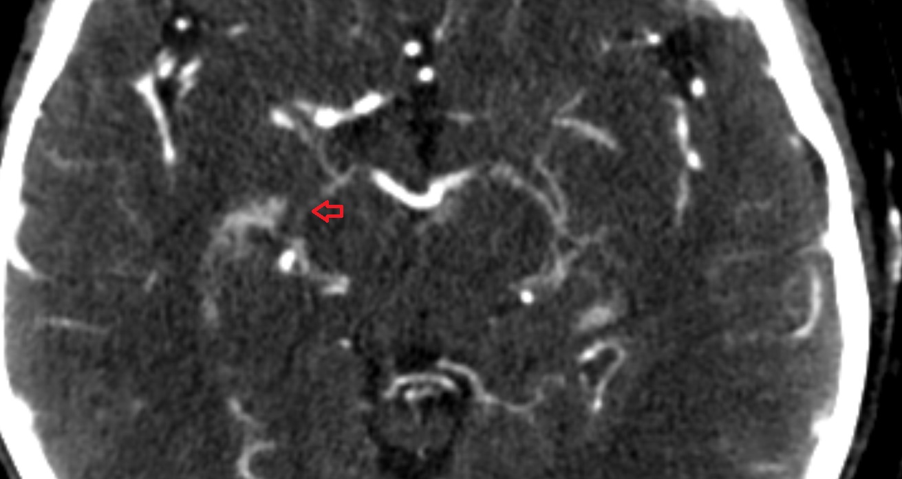 Posterior lateral choroidal artery CT axial anatomy image -img-00001-00001