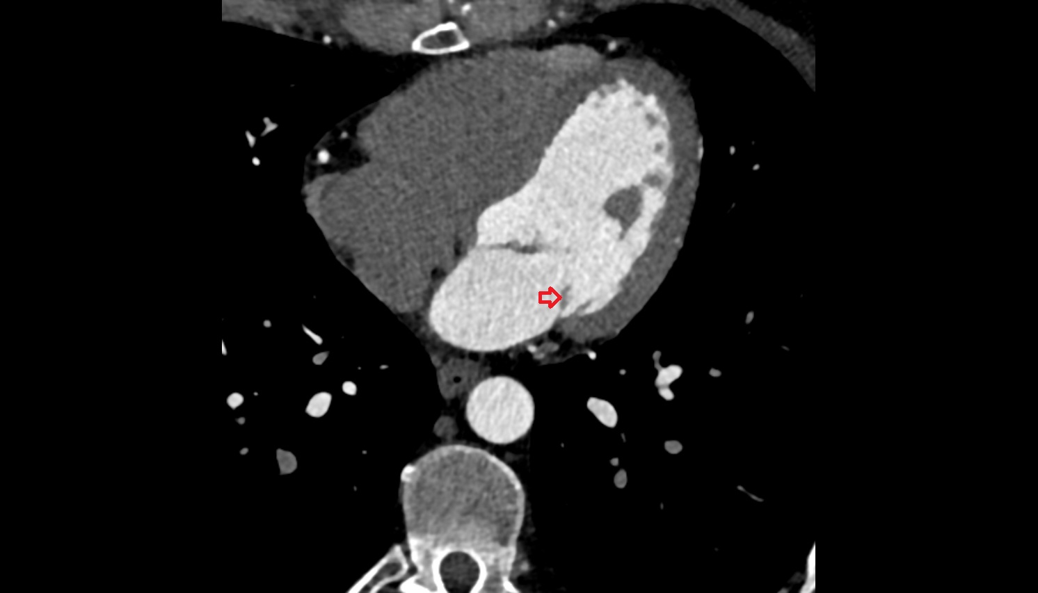 Posterior leaflet of left atrioventricular valve MRI coronal image -img-00000-00000
