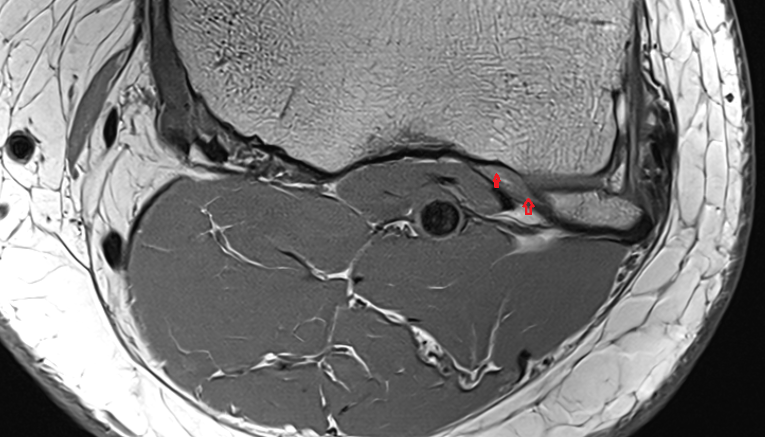 Posterior ligament of fibular head axial  cross sectional anatomy 3T MRI AI enhanced  radiology  anatomy image-img-00000-00000
