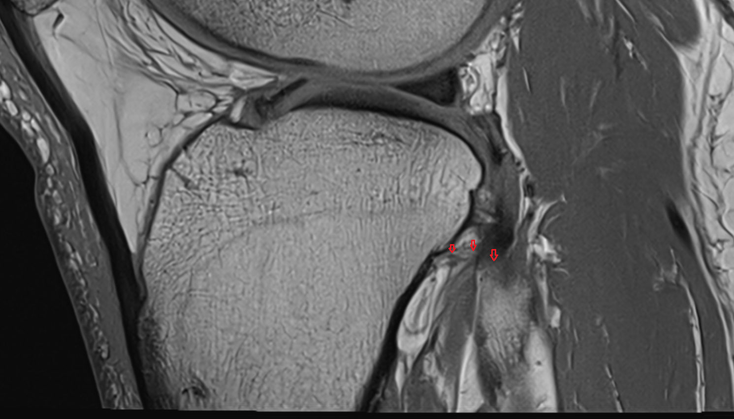 Posterior ligament of fibular head sagittal  cross sectional anatomy 3T MRI AI enhanced  radiology  anatomy image-img-00000-00000