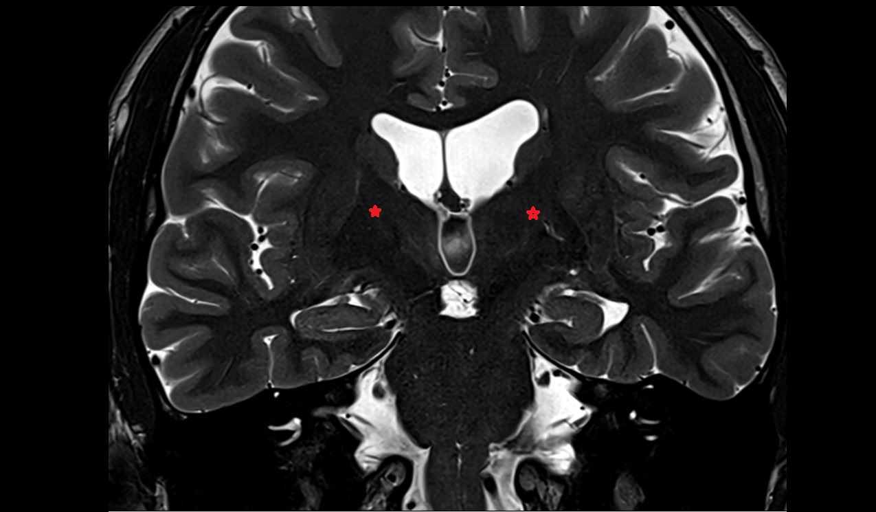 Posterior limb of internal capsule mri 3t coronal image
