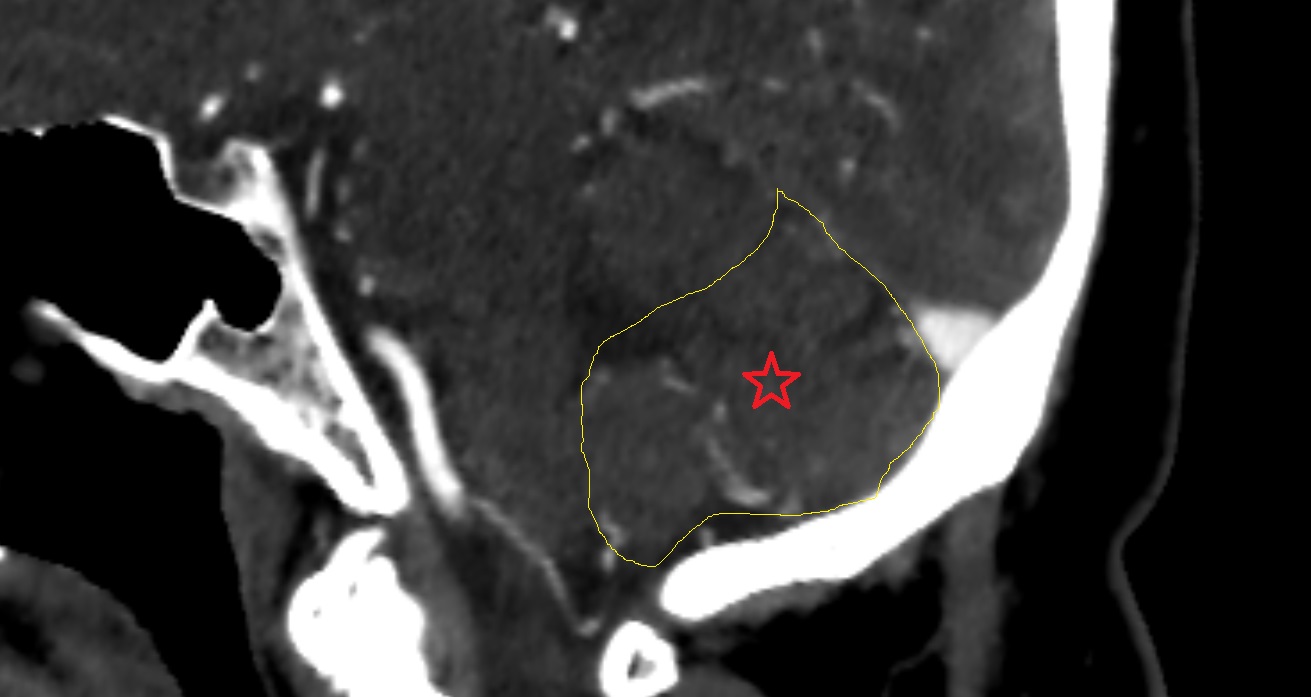 Posterior lobe of cerebellum  CT sag  anatomy image -img-00001-00001