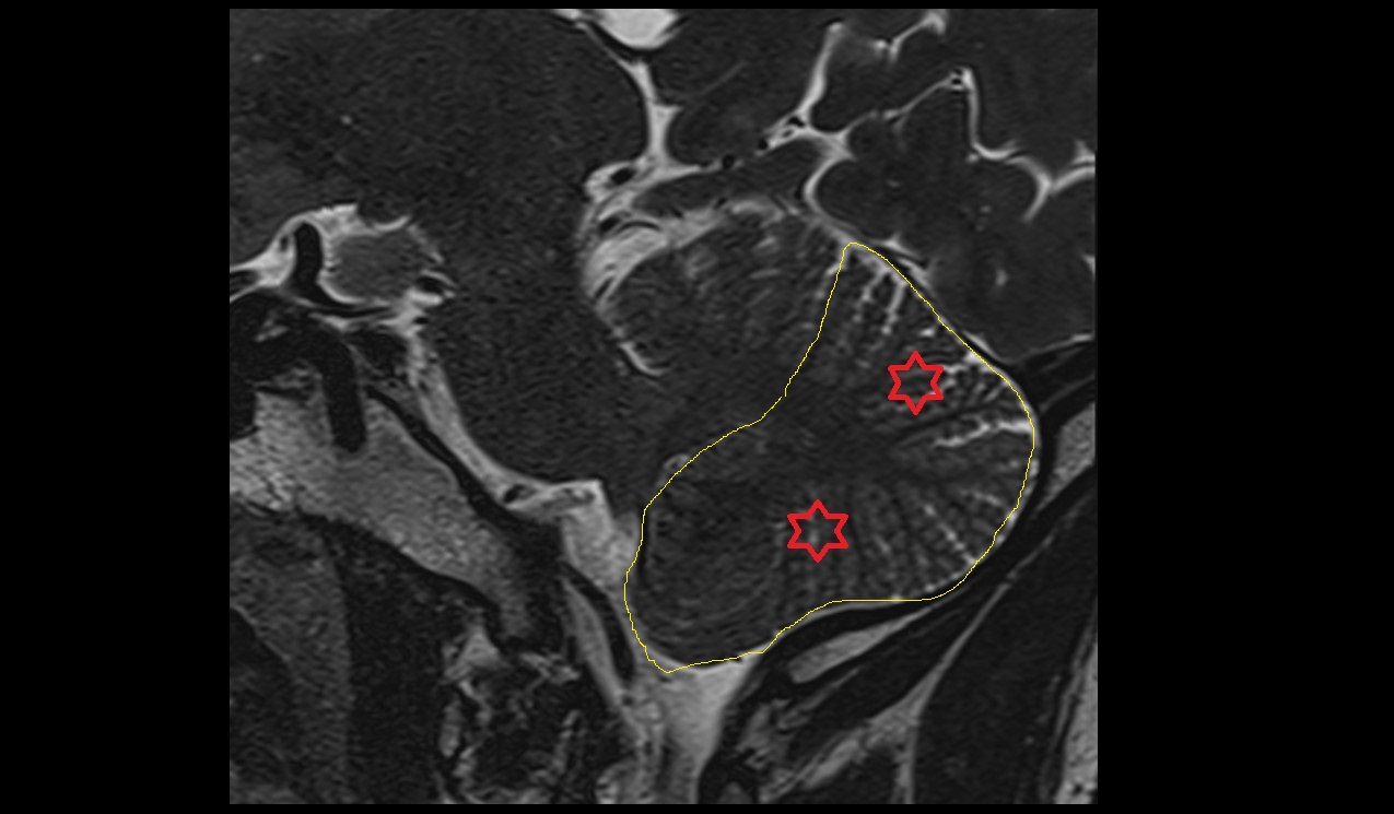 Posterior lobe of cerebellum MRI 3T image