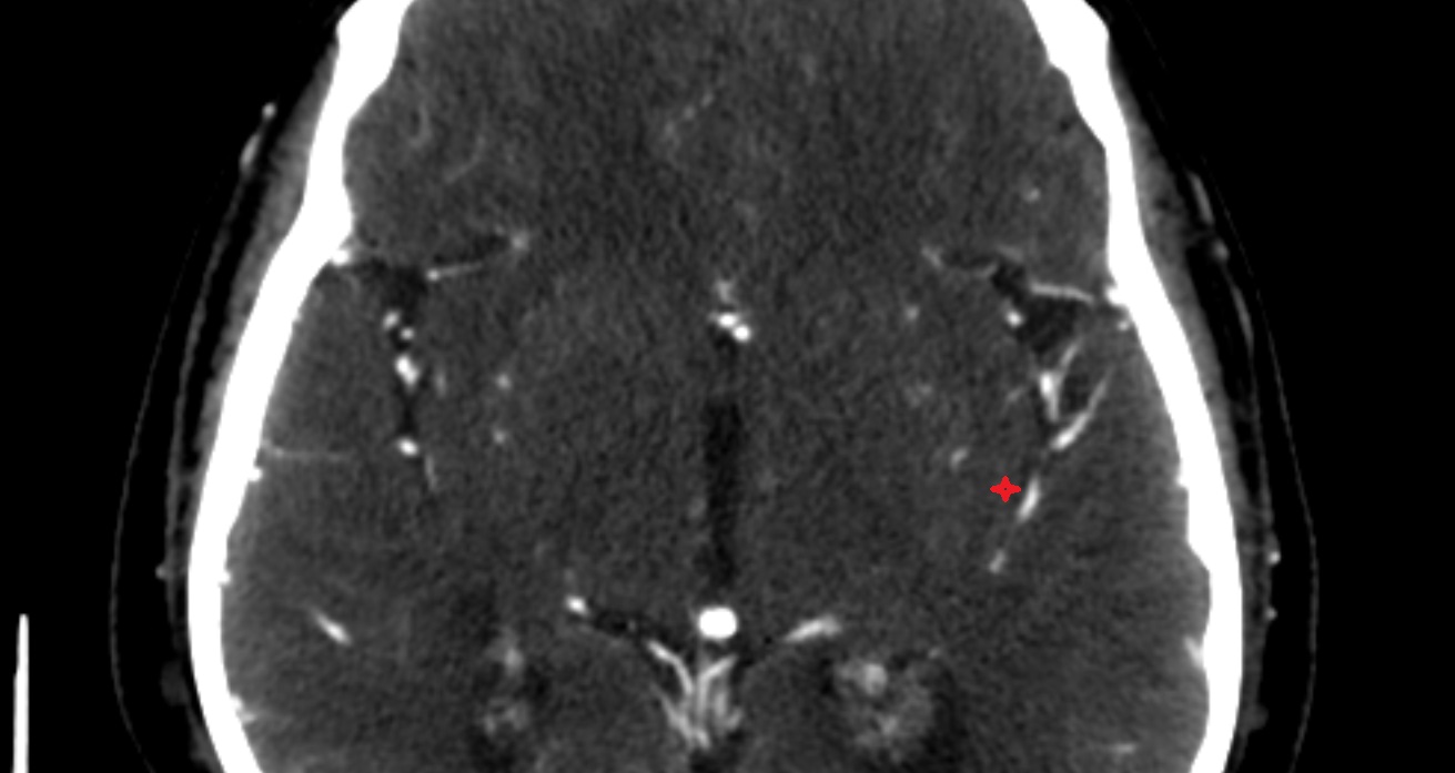 Posterior long insular gyrus  CT  axial anatomy image -img-00001-00001