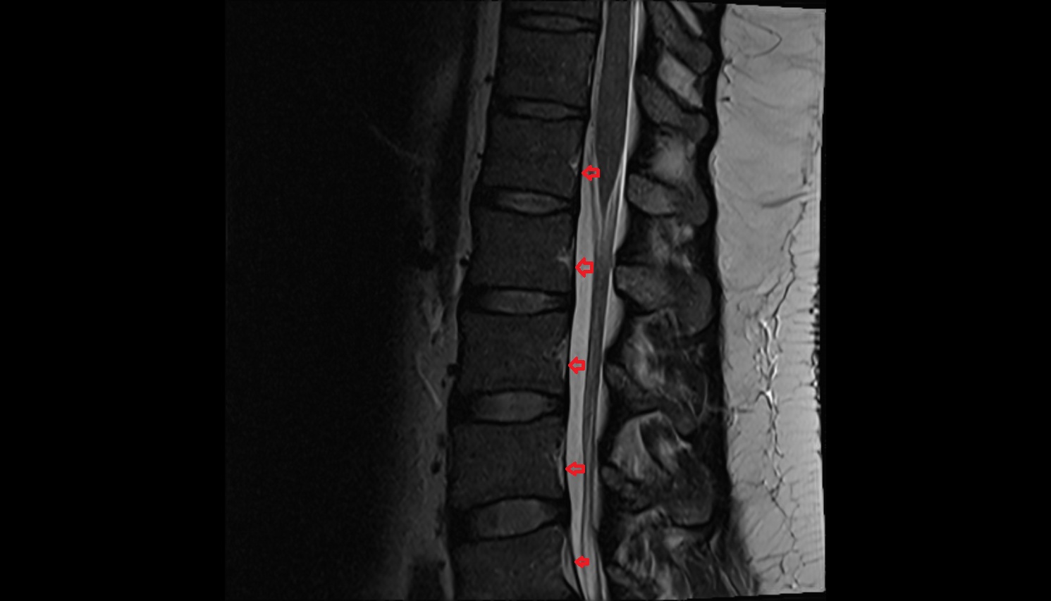 Posterior longitudinal ligament   MRI sagittal  anatomy  image -img-00000-00000