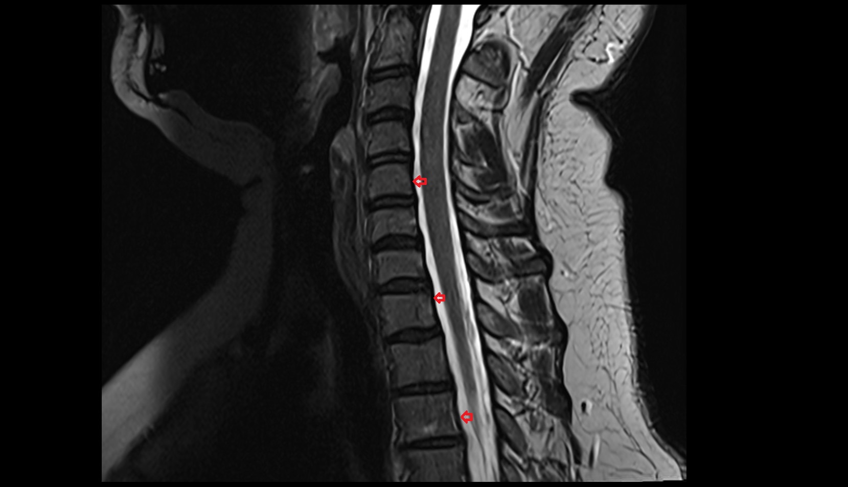 Posterior longitudinal ligament c spine