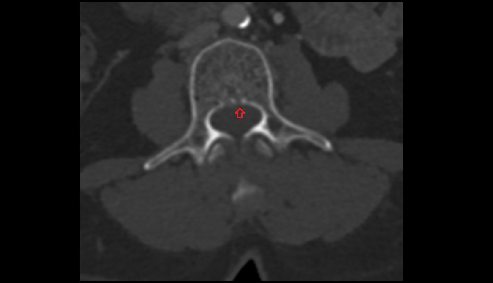 Posterior longitudinal ligament ct axial iamge